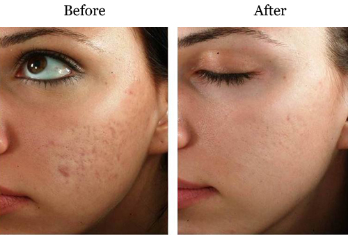 Acne scarring