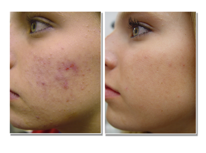 Acne scarring